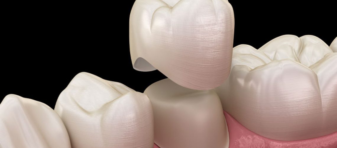 a same-day crown model showing a tooth crown being placed on top of a tooth.