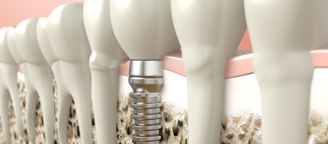 Dental Implant In Bone Surrounded By Natural Teeth