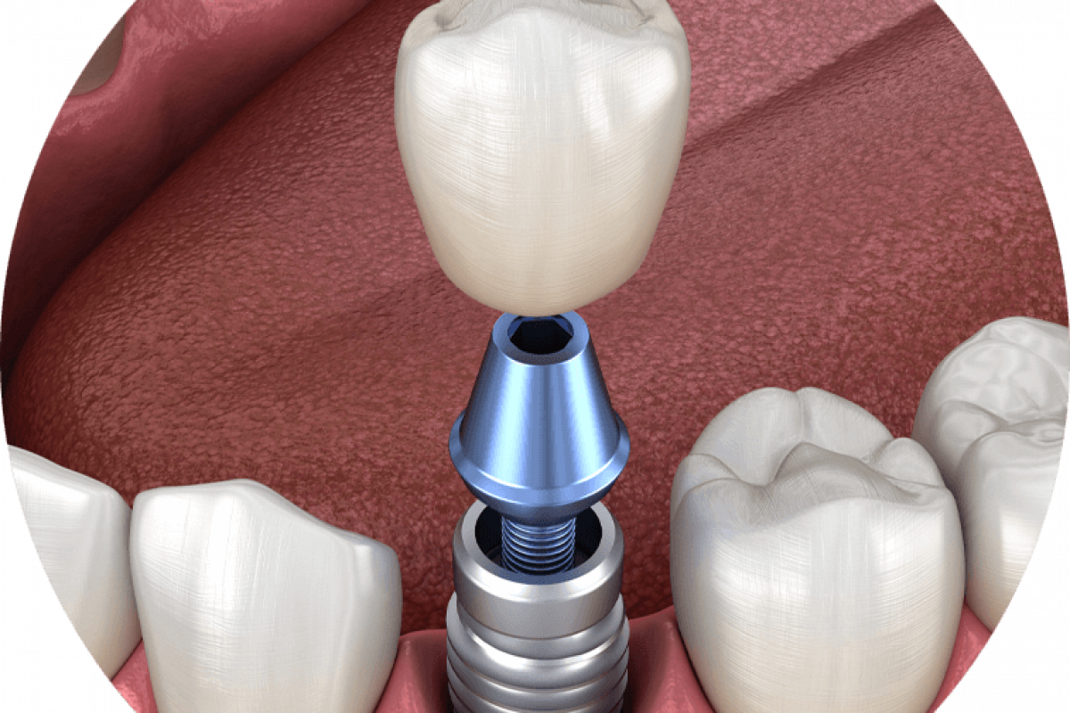 dental implants model.
