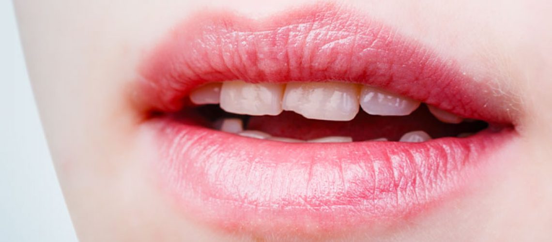 Dental Patient With Chipped Teeth