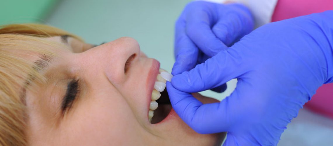 a dental veneer patient receiving porcelain veneers.