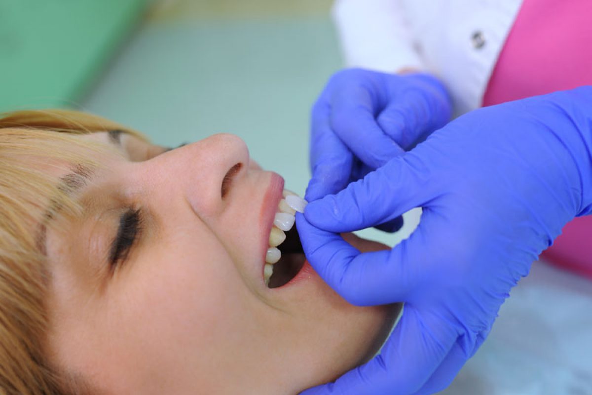 a dental veneer patient receiving porcelain veneers.