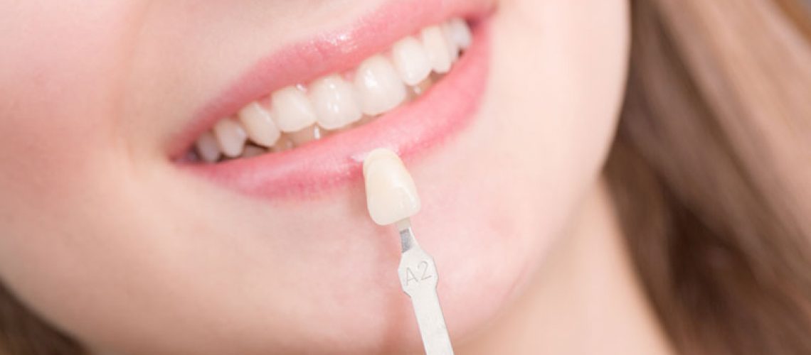 dental veneers patient.