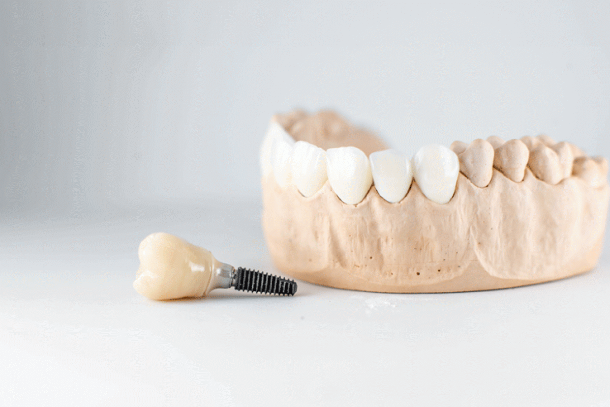 Close-up of dental model with implant. patient of dental clinic on blurred background. dentistry
