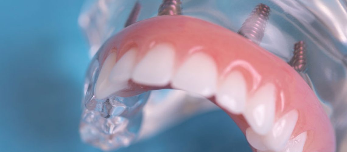 All-On-4 Full Arch Dental Implant Model