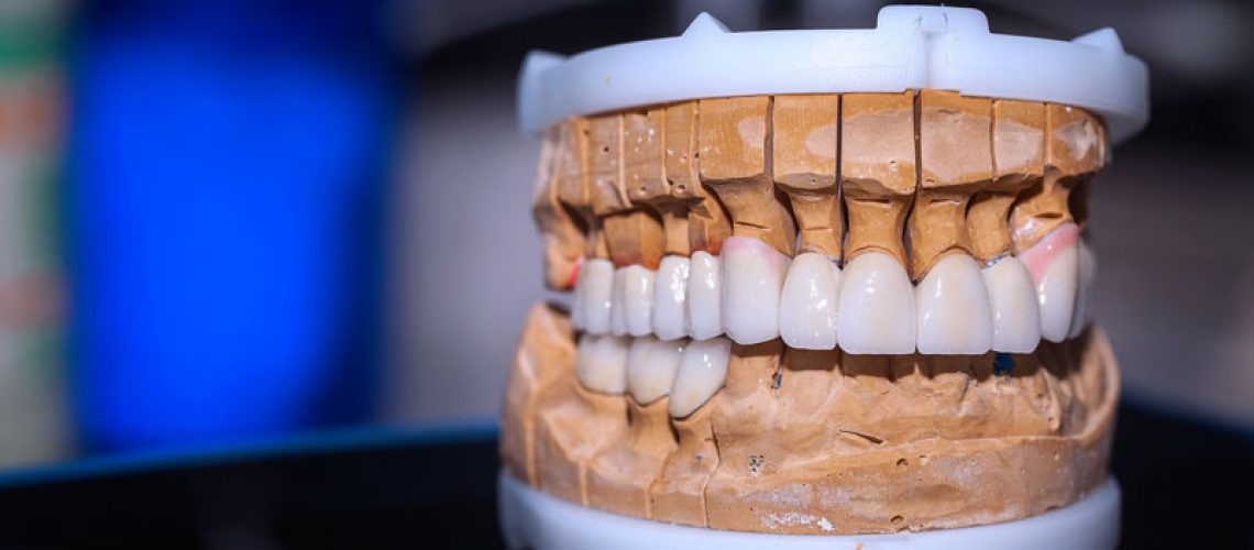 a full mouth dental implant model with dental crowns and a dental bridge.