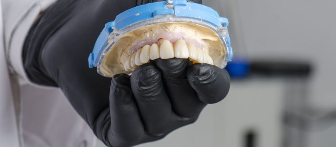 dentist holding full arch dental implant model
