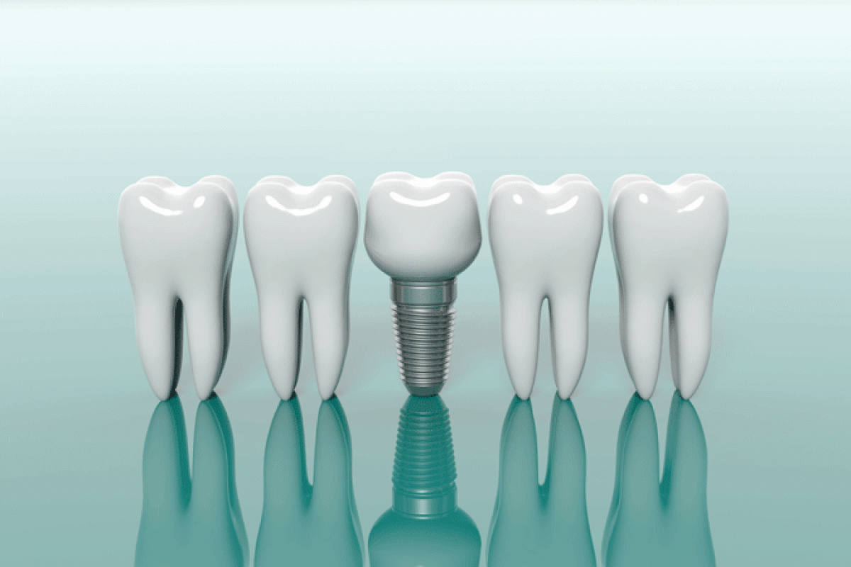 3d model of 4 teeth with a dental implant in the middle of them