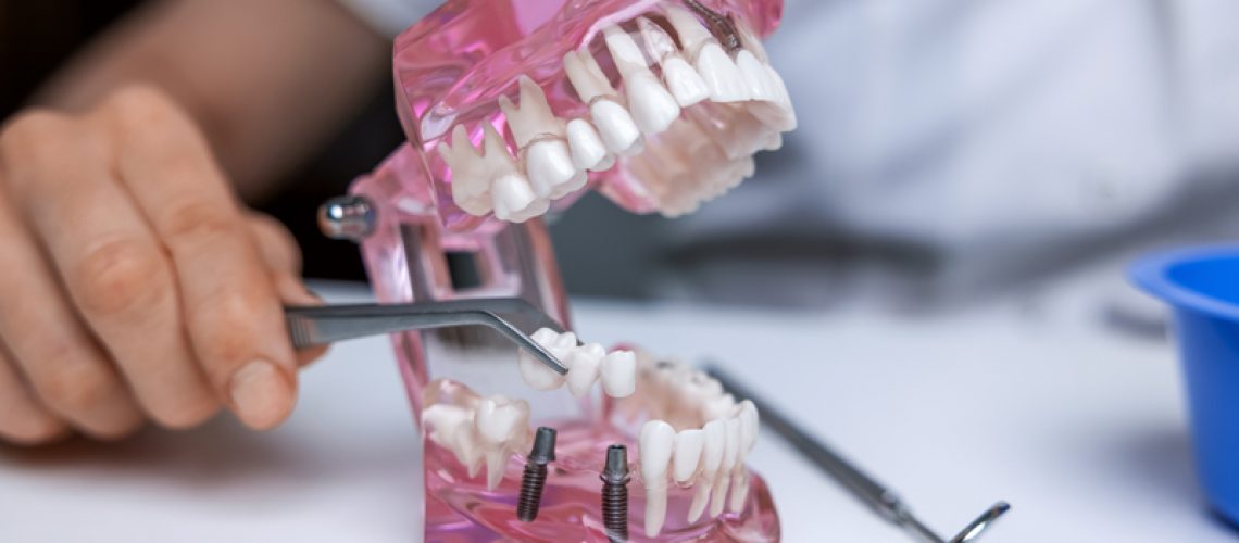 dentist implantologist showing dental bridge implant technology on human tooth jaw model