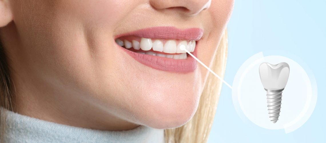 Young woman with implanted teeth on color background, closeup