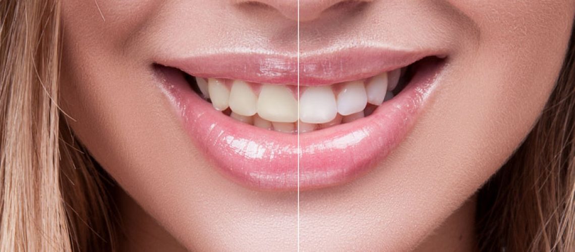 a dental implant patient smiling and showing before and after effect of teeth whitening.