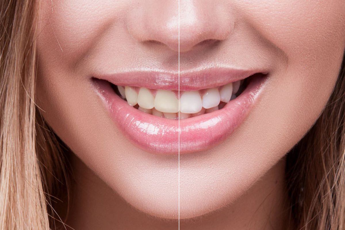 a dental implant patient smiling and showing before and after effect of teeth whitening.